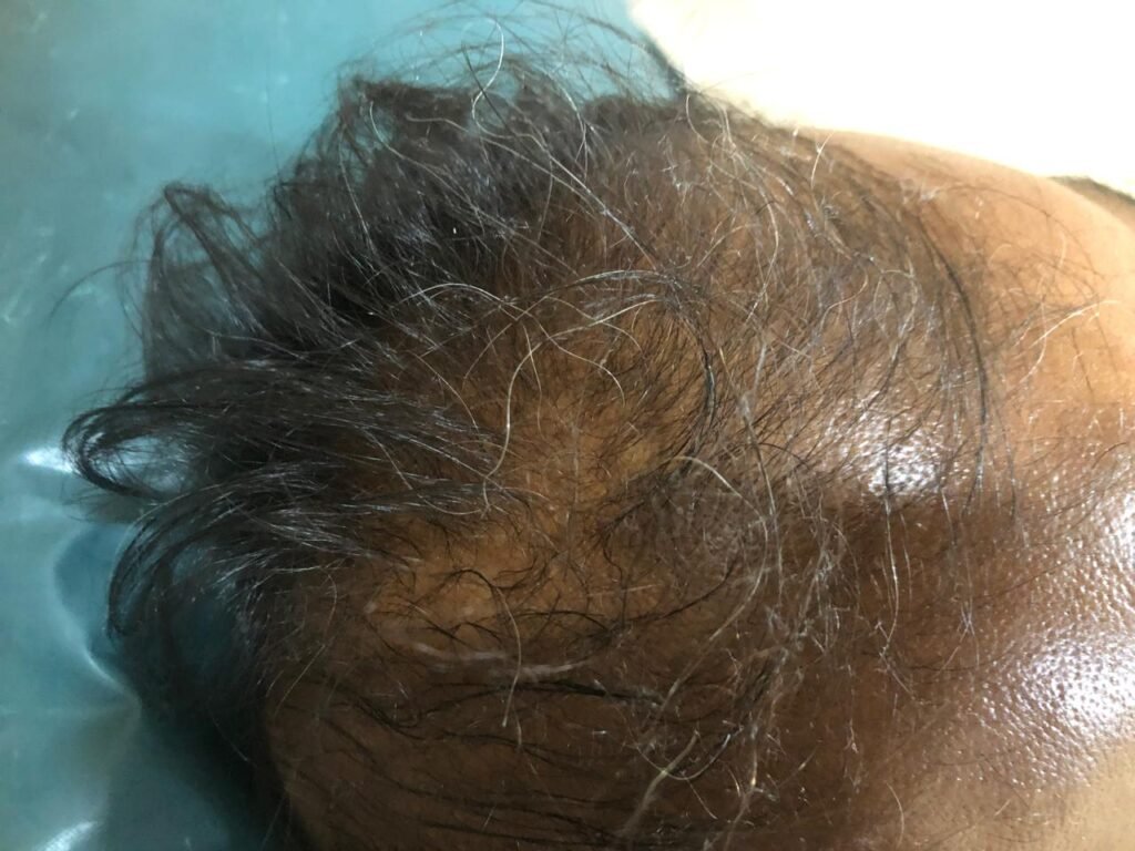LRG Hair Growth Treatment
