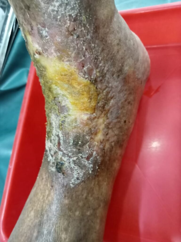 LRG Knee Pain Treatment Coimbatore