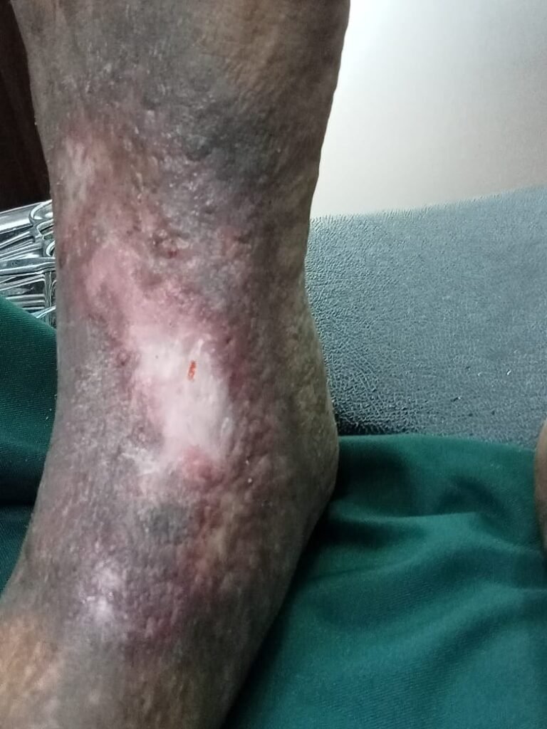 LRG Knee Pain Treatment Coimbatore